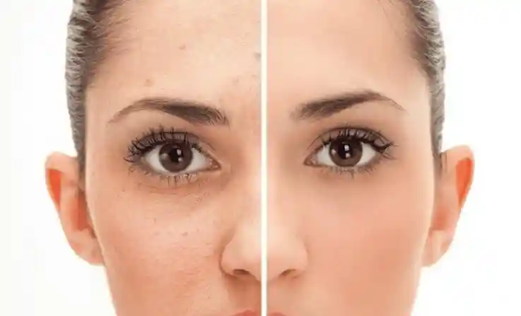 How to get rid of pigmentation using face packs in hindi..